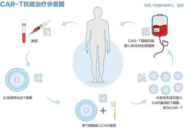 CAR-T疗法价格下降_一针百万元的抗癌药有望大幅降价_纳基奥仑赛医保谈判