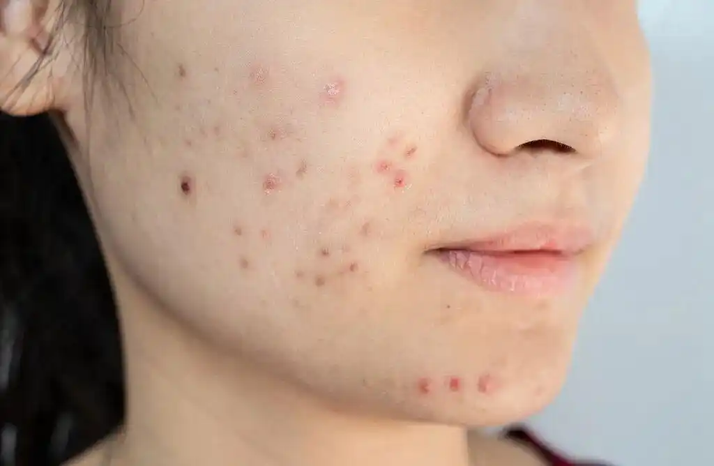 红霉素软膏千万不能随便用_红霉素软膏正确使用方法_红霉素软膏滥用场景