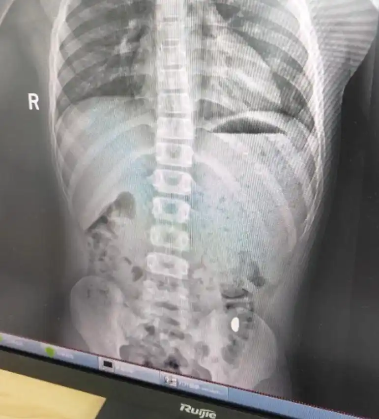 熊孩子误吞10克金豆6天后排出_金豆子吞下去如何处理_误吞金豆子怎么办