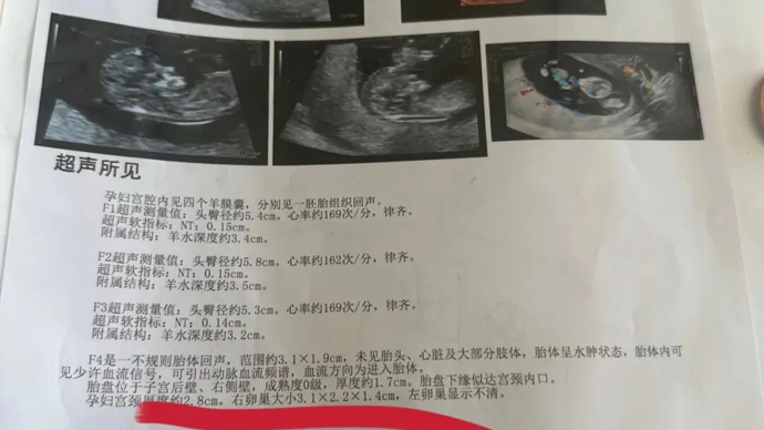 奇！每次产检都发现多出一胎！孕妇两个月内从一胎变四胞胎！医生：同卵四胞胎