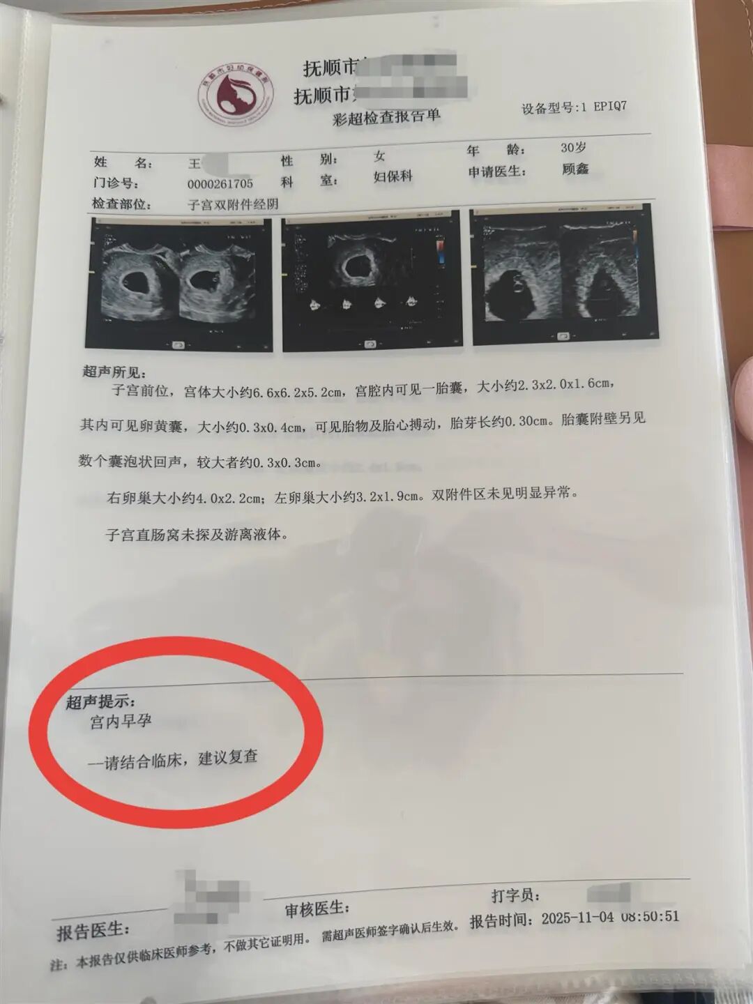 辽宁一孕妇两个月内从一胎变四胞胎_怀四胞胎同卵四胞胎无心畸胎_四胞胎产检发现无心畸胎