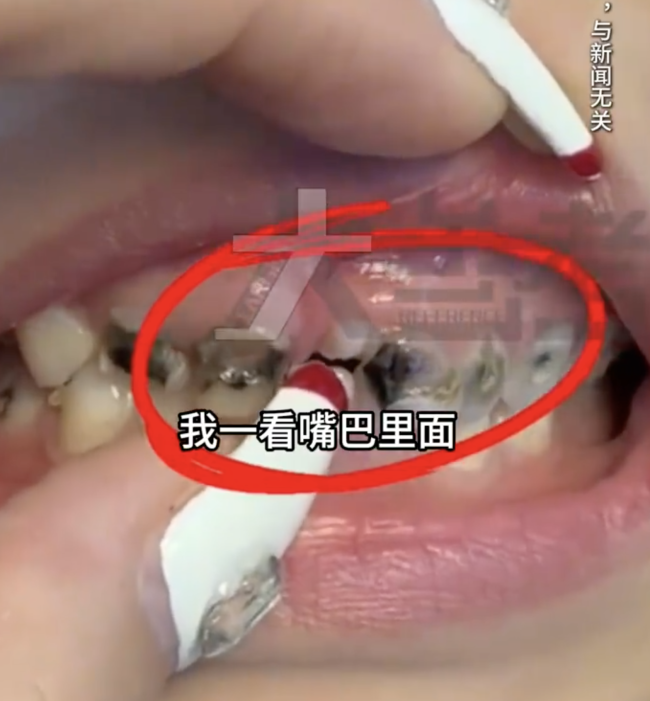 男孩酷爱喝可乐 20颗乳牙坏了16颗！乳牙烂了不治，后果有多严重？